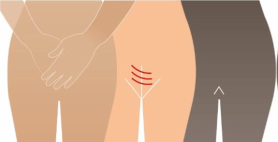 Female Genital Mutilation/Cutting FGM/C